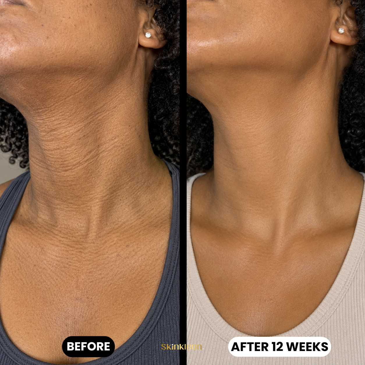 Baby Collagen NECK Mask